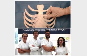 Malformazione della gabbia toracica, impiantata al Meyer la prima protesi 3D 'riassorbibile' in Europa