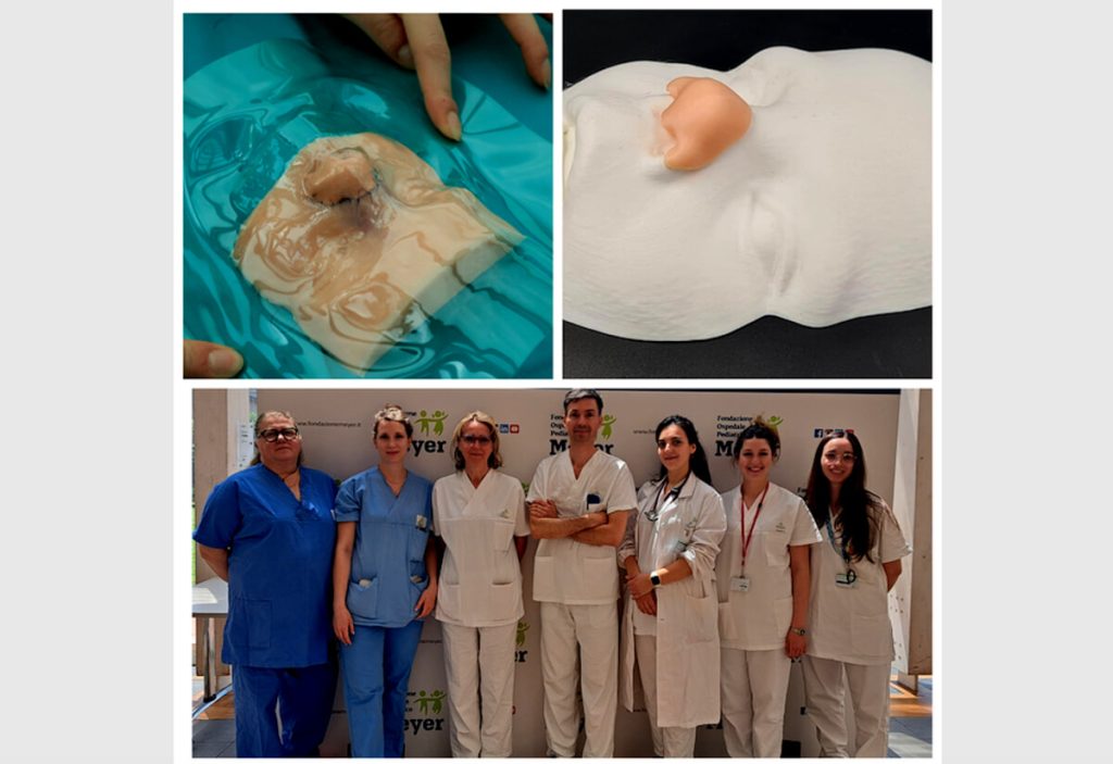 Al Meyer ricostruito il naso a un bambino grazie alla stampa 3D e al fratellino gemello. La gioia della mamma / FOTO