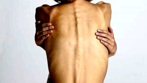 Anoressia nervosa e perdita di realtà  Podcast